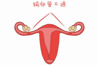 (a)去哪里做代孕好,女人输卵管不通会怎样？这3个危害，备孕的你需要知道