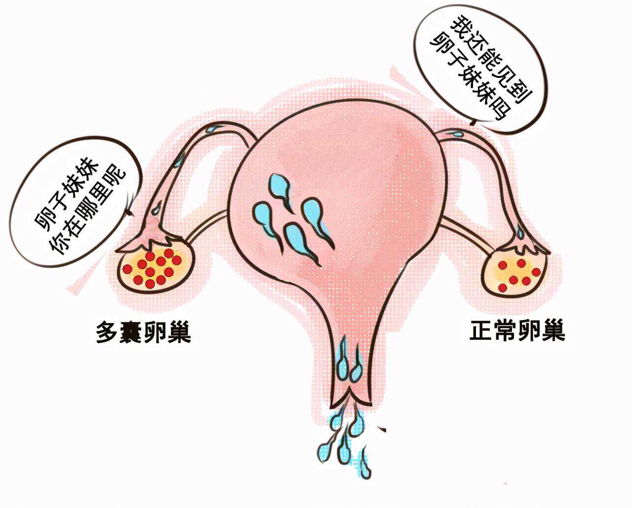 (a)代孕妈是怎么样,怎么做到多囊卵巢成功备孕？掌握这些技巧怀宝宝不会